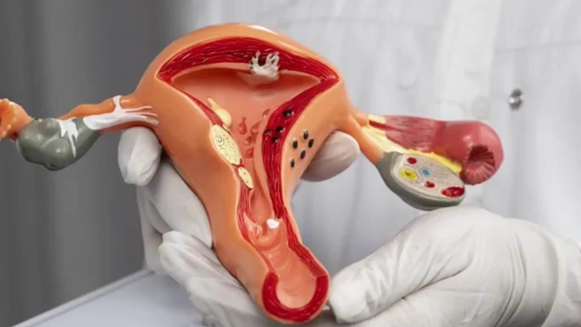 Fallopian Tube Blockage